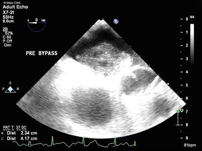 Case Report: A myxoma with a far reach